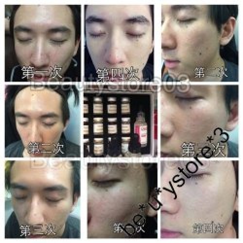 DERMIER RESTING PEEL 海藻矽針 (3款組合) DERMIER RESTING PEEL 海藻矽針 (3款組合)
